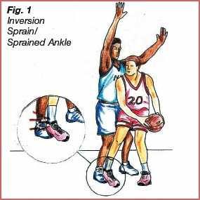 17.9.2013 NILKKAVAMMAT 59 Nilkan nyrjähdys on yleisimpiä koripalloon liittyviä urheiluvammoja tyypillisin vamma on nilkan ulkosivun