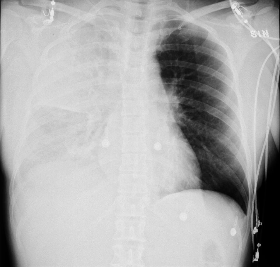 Pneumonian komplikaatiot -Perusterve potilas voi menehtyä pneumokokkipneumoniaan!
