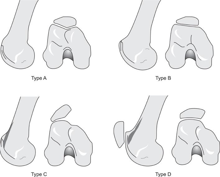 MT tutkimusta suositellaan käytännössä kaikille patellaluksaatiopotilaille. MT:assa tarkistetaan rustotilanne, TT-TG, luuödeemat ja ligamenttivauriot.