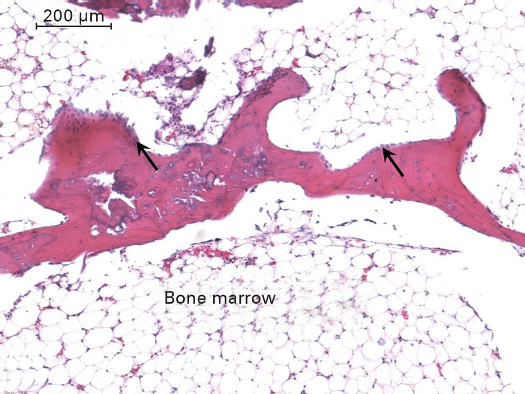 Metaboliset luustosairaudet Osteoporoosi Osteomalasia Hyperparatyroidismi