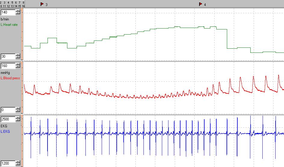 EKG Verenpaine Syke