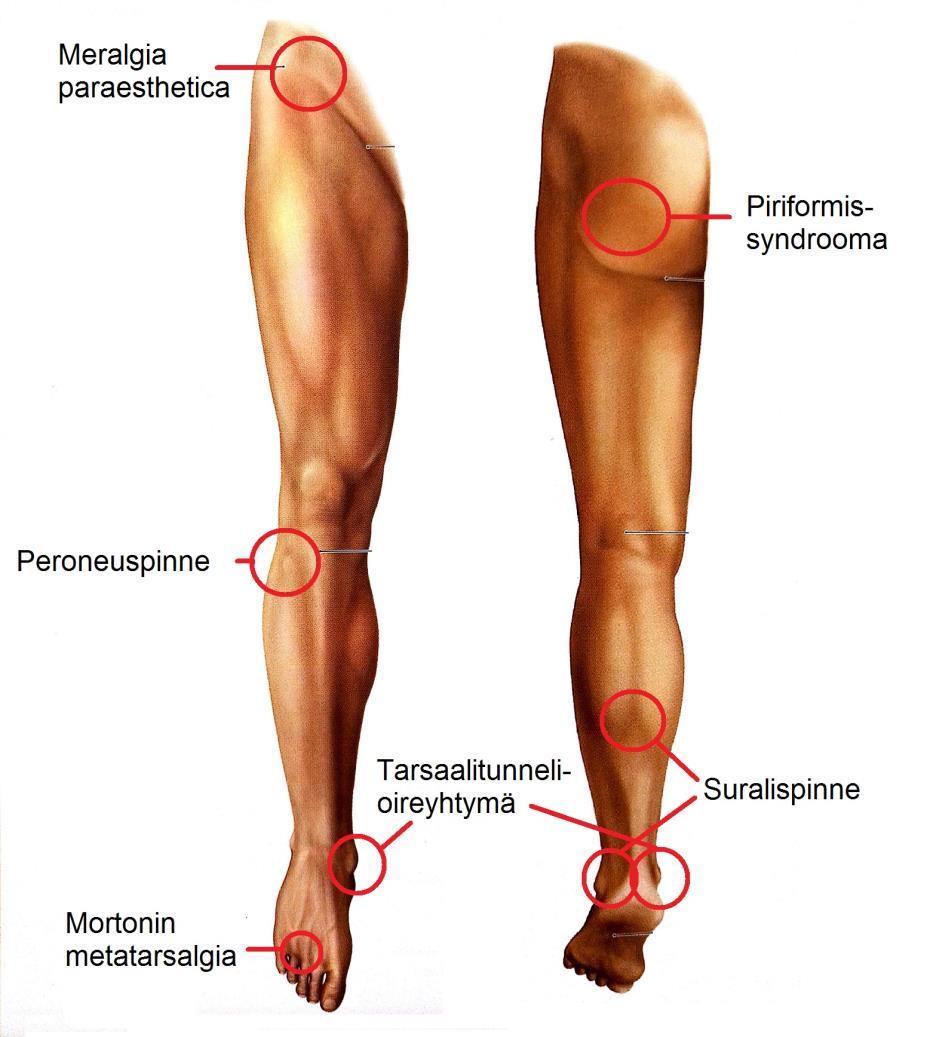 29 (KUVA 12). Syndrooma aiheuttaa pakaran alueen kipua, joka provosoituu lonkan passiivisessa sisärotaatiossa ja lonkan koukistuksessa. (Soinila & Launes 2007, 515-517.) KUVA 12.