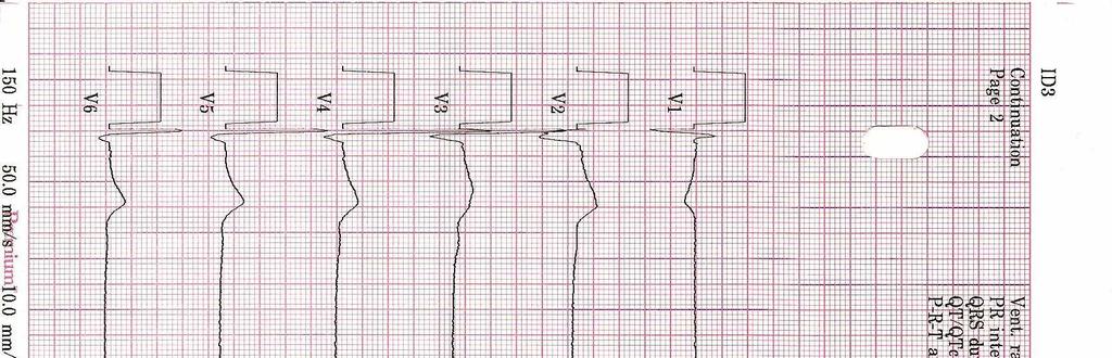 Kamppailulajiharrastajille tyypilliset lepo-ekg-käyrässä näkyvät  sydänmuutokset - PDF Ilmainen lataus