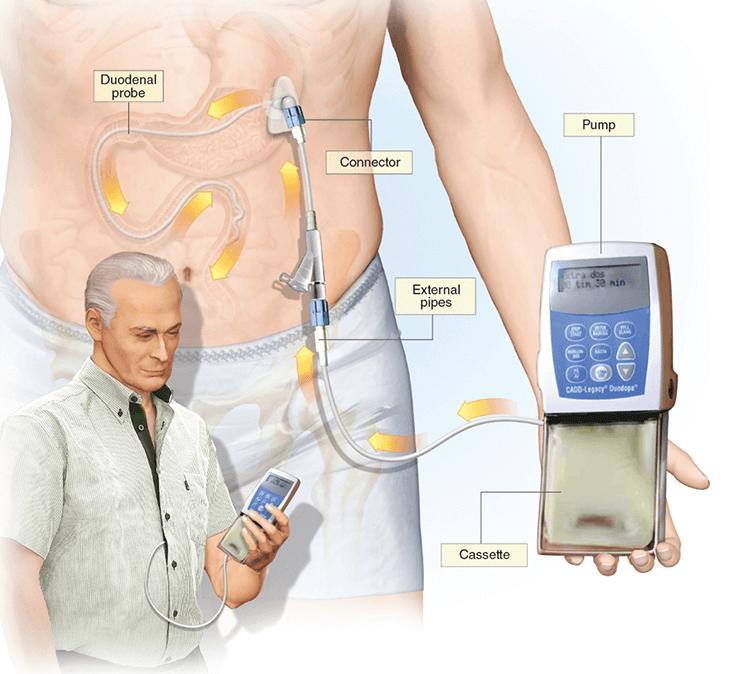 PARKINSONIN TAUTI JA MS JA ALS: ETIOLOGIA, PARKINSONISMIKIRJON SAIRAUDET,  DIAGNOSOINTI JA UUSIMMAT HOITOMUODOT - PDF Free Download