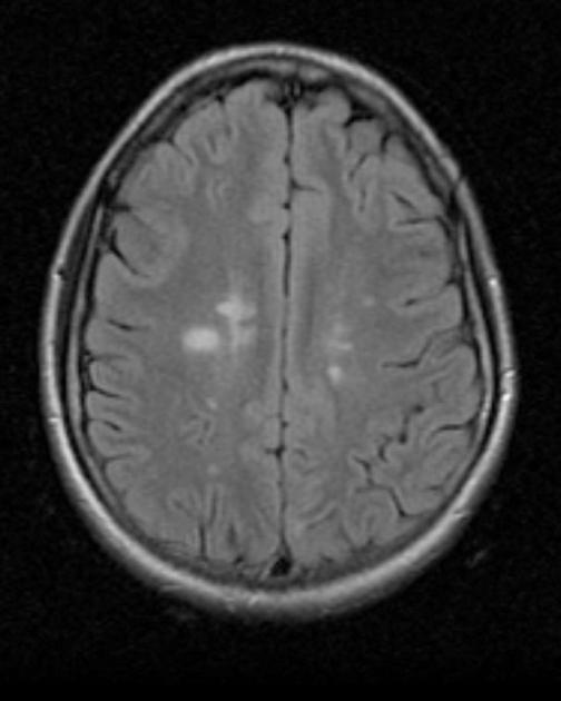 MS-TAUDIN DIAGNOOSI TEHDÄÄN Kliinisen oirekuvan Pään MRI:ssä