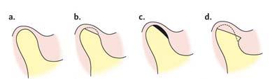 Kondyylin patologiset muutokset (a) Normaali kondyyli (b) Nivelpinnan viistemuodostus (c) Nivelpinnan alainen skleroosi (d) Nivelpinnan