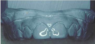 CHX-geeli Kariesprofylaksiassa geelin tarkoituksena on vähentää mutans streptokokkien määrää hampaistossa ja siten alentaa kariesalttiutta Geelipuhdistus vastaanotolla: 3-4 kertaa muutaman viikon