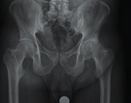 Potilaalla on pitkälle edennyt vasemman lonkan nivelrikko. Leikkauksen jälkeinen röntgenkuva, jossa näkyy asennettu lonkan tekonivel.
