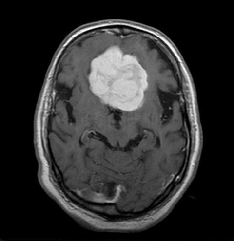 18 Kuva 3: Meningeooma