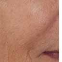 JÄLKEEN Tulosten ylläpito Juvédermin Skin Quality pistoshoito ENNEN häivyttää juonteita ja kosteuttaa ihoa sekä