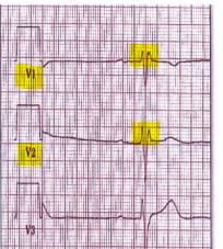 26 eli sen huomatessa tulisi EKG- rekisteröijän aina tarkistaa V 1 ja V 2 -elektrodien paikka ja korjata se sekä muut elektrodit niitä vastaaviksi.