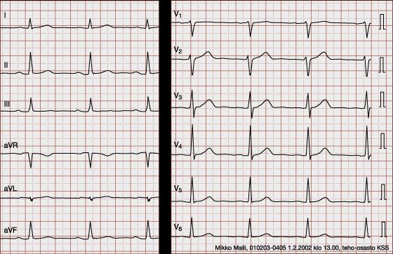 5 5 Elektrokardiografia eli EKG EKG (kuvio 1) rekisteröi sydämen sähköistä toimintaa. Elimistössä on runsaasti suolaista vettä, joka johtaa hyvin sähköä.