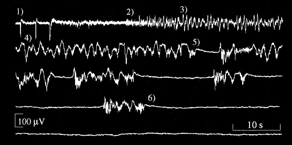 Syvenevän inhalaatioanestesian EEG Kaisa