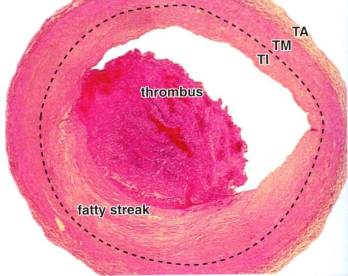 Trombosyyttitulppa =Primaari hemostaasi 4.