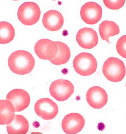 Veren neljä pääelementtiä: Punasolut (erytrosyytit) kuljettavat verikaasuja Verihiutaleet (trombosyytit) tarkkailevat verisuonten seinämiä ja
