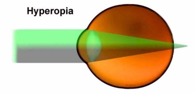 (hyperopia) - Hajataitteisuus