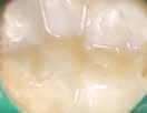 optimaalista bulk fill ultra universal restorative material Vain yksi sävy Kapseli- ja