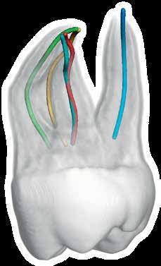 3D Endo -ohjelma on ensimmäinen esimerkki siitä, kuinka Dentsplyn ja Sironan tuotekehitykset ovat yhdessä onnistuneet parantamaan suun terveydenhoitoa.