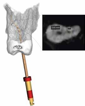 Intuitiivinen 3D Endo -ohjelma ja sen raportointityökalut auttavat juurihoidon tarpeen ja prosessin viestittämisessä potilaalle aivan uudella tavalla.