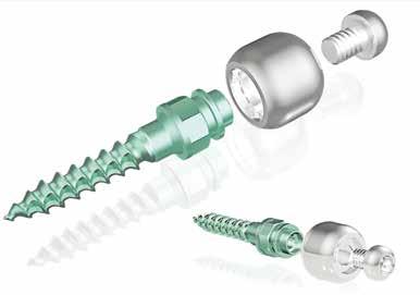 44680 MicroSprint 706-1094 kit ik, 20 kpl (K=koukku) 44681 MicroSprint 706-1094 kit 3K, 20 kpl 44682 MicroSprint 706-1094 kit 3-5K, 20 kpl Ortho Easy PAL Mini-implantit Mahdollistaa kojeen