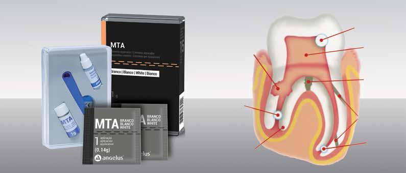30495 MTA Repair HP, 2 x 0,085 g 30496 MTA Repair HP, 5 x 0,085 g 61 e *49,19 e 137 e *110,48 e MTA Fillapex Endodonttinen juurentäyteaine MTA:n