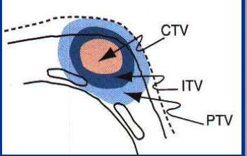 ITV=Internal target volume= sisäinen kohdealue potilaan sisäisten elinten ja kudosten liike, muodon ja koon muutokset esim.