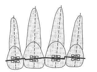 Standardibraketti Torquebraketti Kaarilankaan taivutetaan hampaan angulaatiota säätelevät