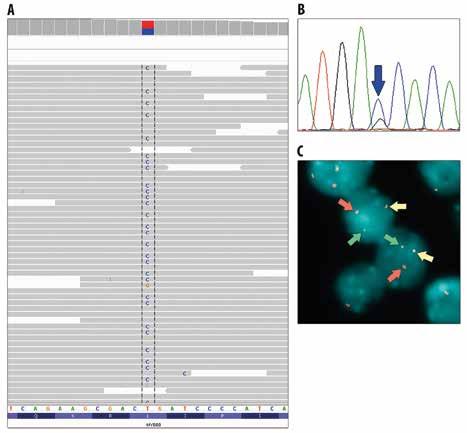 KUVA 3. Lymfoomien geenivirheiden tunnistaminen. A) MYD-syöpägeenin aktivoivan L265P-pistemutaation todentaminen uuden sukupolven sekvensointimenetelmällä.