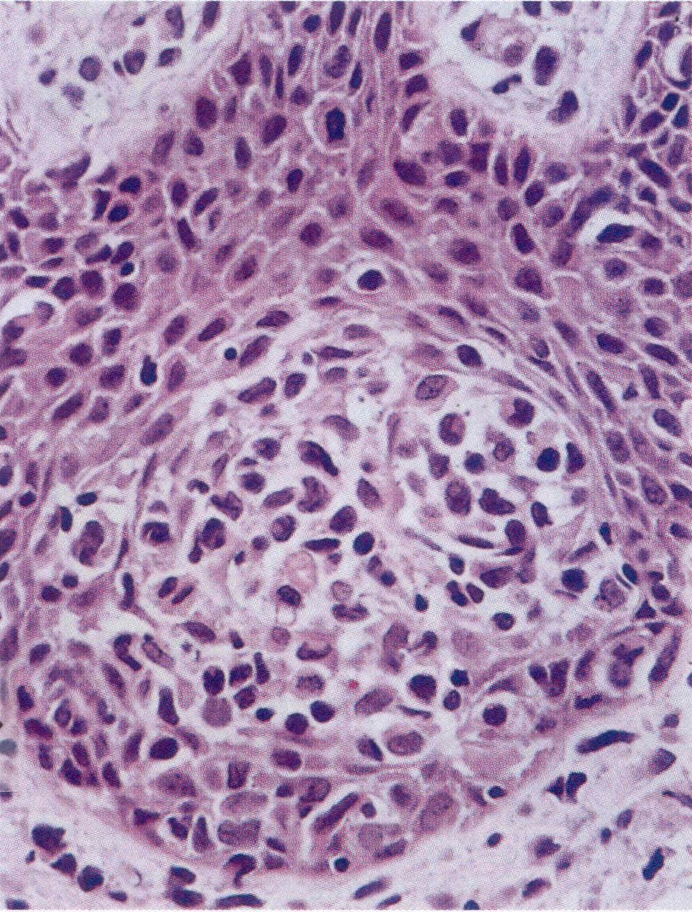 T-solu lymfoomat Pautierin abskessi