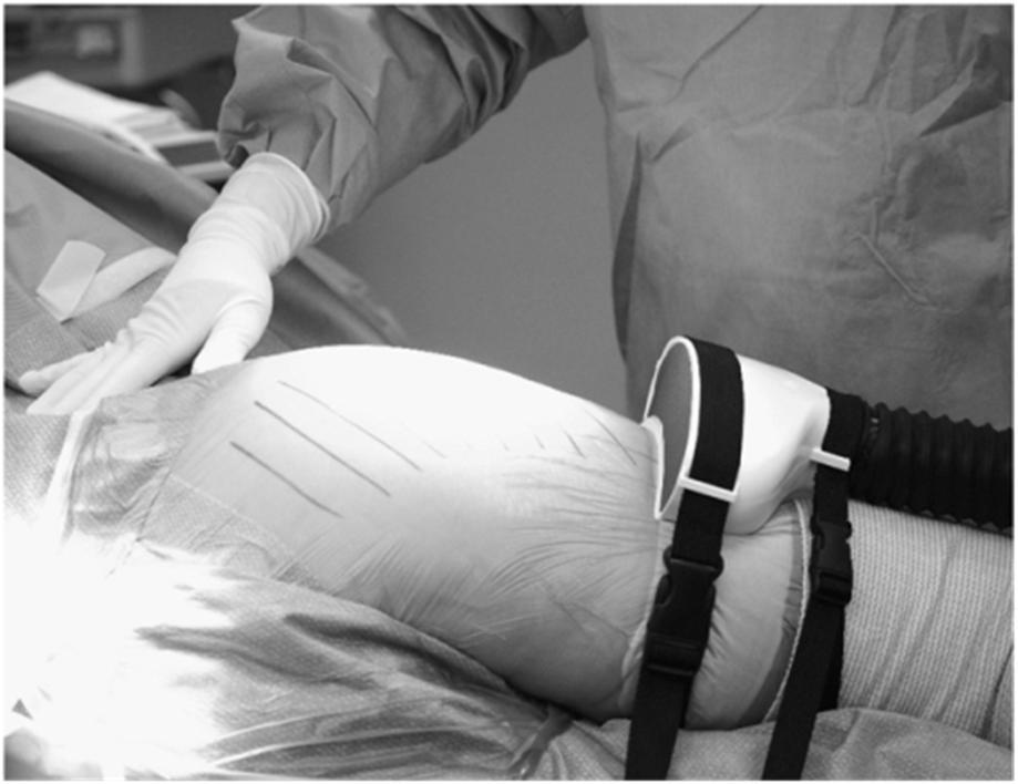 14 Leikkausalueen hiukkaspitoisuuden alentaminen Laminaari-ilmanjaosta huolimatta leikkausalueelle kulkeutuu huomattavasti hiukkasia leikkausprosessista ja henkilöistä Leikkausalueen