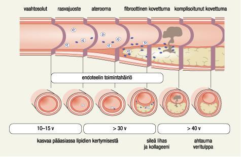 9 erilaisissa yhteyksissä. (Kuisma ym. 2008, 257.) Suonen tukkeutuessa kokonaan, potilas saa sydäninfarktin (Castren ym. 2010, 291; Vauhkonen ym. 2005,48; Holmia ym. 2003, 201).