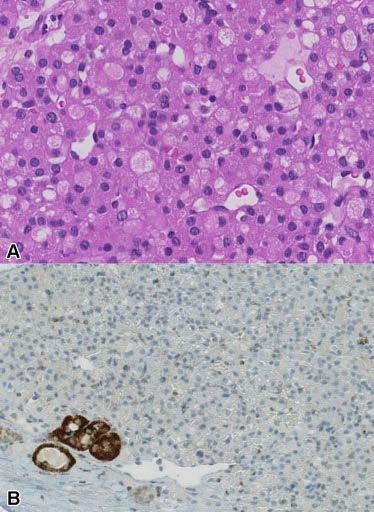 SDH deficient RCC