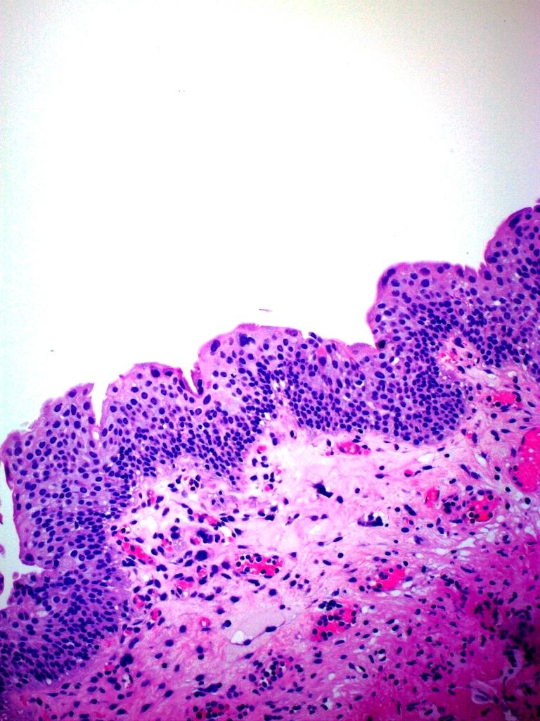 Urothelial proliferation of