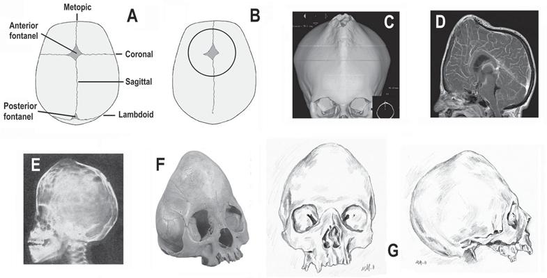 Beheaded man from Hailuoto Fig. 5. Representations illustrating oxycephaly: (A) Superior view of a normal infant cranium with sutures and fontanels.