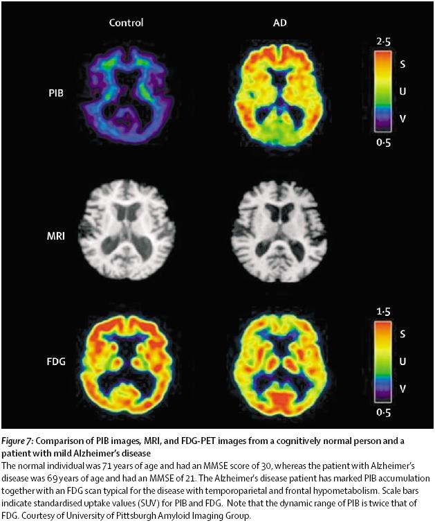 AD: Imaging Ab plaques using the PET technique - PIB, Pittsburgh Compound-B measuring Ab plaques - MRI, magnetic resonance imaging - FDG, [ 18