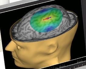 Nexstimin tekniikan sovelluskohteet Tekniikka Sovelluskohteet tämänhetkiset painopisteet Hoito Navigoitu aivoterapia (Navigated Brain Therapy, NBT) Diagnostiikka Navigointiavusteinen aivostimulaatio