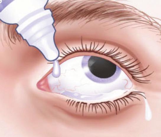 3. Levitä 10-prosenttista povidonijodiliuosta tai vastaavaa periokulaari-iholle, luomille ja silmäripsille, ja peitä silmä steriilillä peitteellä. 5 4. Aseta steriili silmäluomenlevitin paikoilleen.