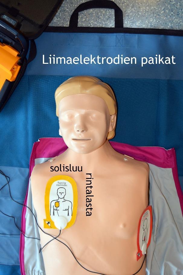 Rintalastan oikealle puolelle tuleva liimaelektrodi