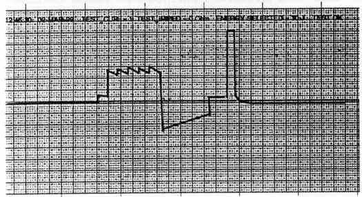 defibrillaattorissa tulostuvat myös defibrillointivastus (DEFIB IMPEDANSSI) ja annettu virta (POTILAS VIRTA).