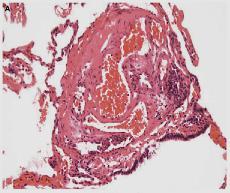 Plexiform lesion Arteritis Merkki