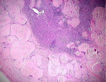 rituksimabi Klorambusiili + prednisoni Amyloidiproteiineja Huonoliukoisia, kertyvät eri elimiin Lähtöproteiineja n.