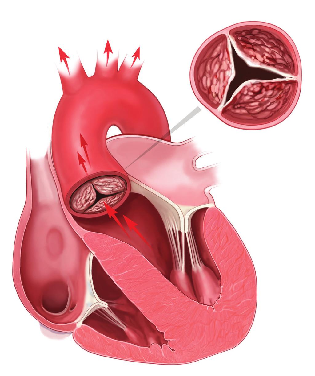 Aortta on ihmisen suurin valtimo. Se lähtee sydämen vasemmasta kammiosta ja vie hapekasta verta kaikkialle elimistöön.