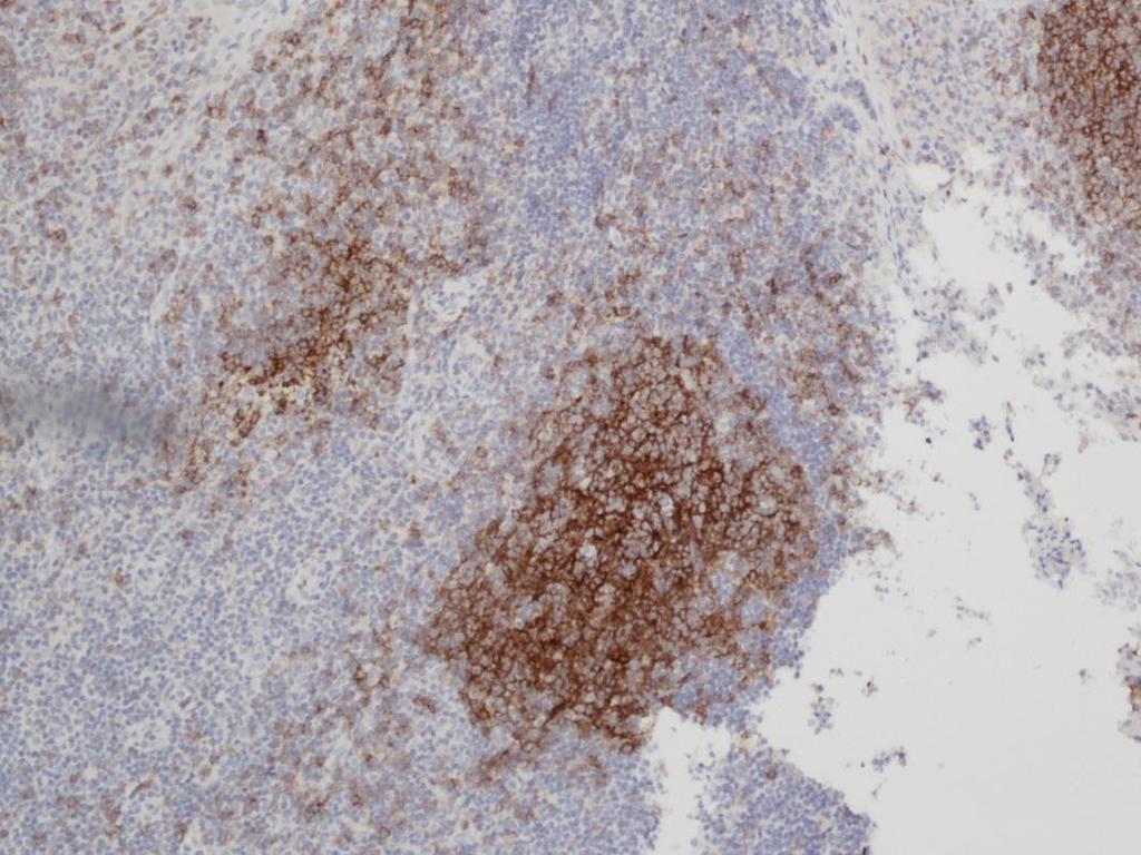 10 Novocastra TM Liquid Mouse Monoclonal Antibody CD21 CD21-antigeeni on proteiini kypsien B-solujen sekä lymfoidisen kudoksen follikulaaristen dendriittisolujen (FDC) solukalvolla.