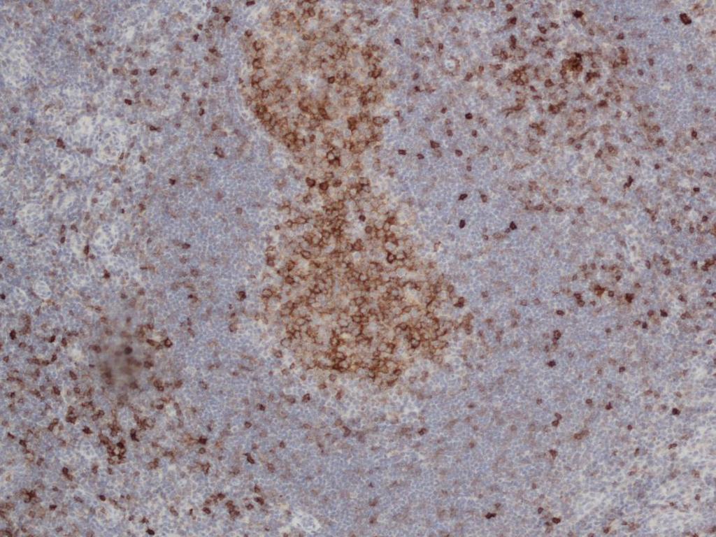 Novocastra TM Lyophilized Mouse Monoclonal Antibody Interleukin-2 Reseptor (CD25) 12 CD25-antigeeni on yksiketjuinen glykoproteiini.