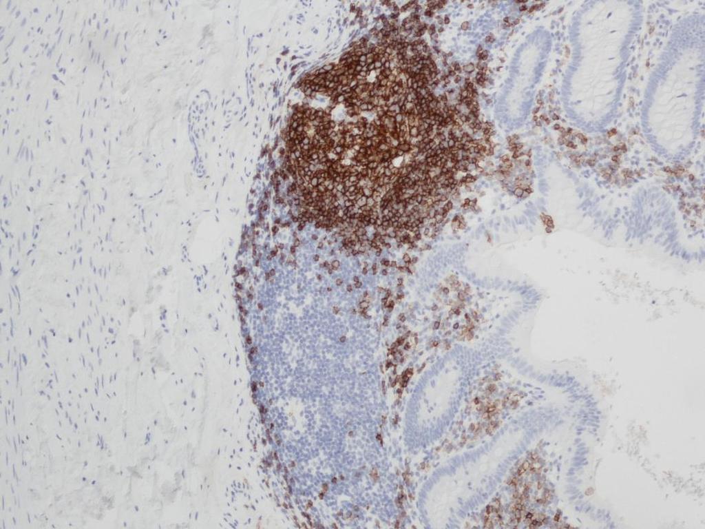 6 Novocastra TM Liquid Mouse Monoclonal Antibody CD19 CD19-antigeenia on havaittu ilmentyvän B-solulinjan solujen ulkokalvolla.
