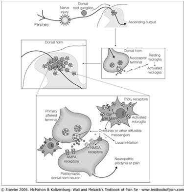 Selkäytimen segmentaalinen disinhibitio (=inhibitio ) Selkäytimen segmentaalisen disinhibition eräs syy: hermovaurion jälkeen kloridia solusta ulos vievä pumppu ei toimi => kloridia kertyy soluun =>
