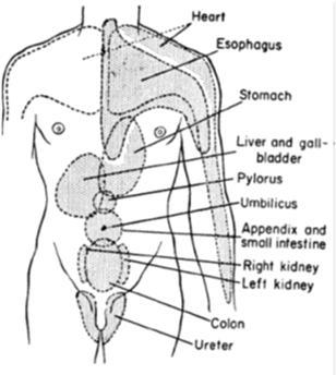 2010) Kaukokipu (referred pain) Sisäelinkipu voi heijastua iholle Mekanismi: Samasta jaokkeesta lähtöisin olevan sisäelimen ja ihon ääreishermot konvergoivat selkäytimessä