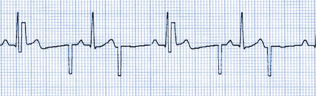 Tahdistus/kardioversio Valvonta EKG-valvonta Tahdistus 1. Aseta OneStep-tahdistuselektrodit tai OneStep Complete - elektrodit potilaan iholle.