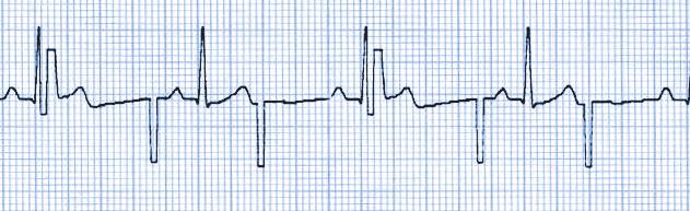 Tahdistus/kardioversio Valvonta EKG-valvonta Tahdistus 1. Aseta OneStep-tahdistuselektrodit tai OneStep Complete - elektrodit potilaan iholle.