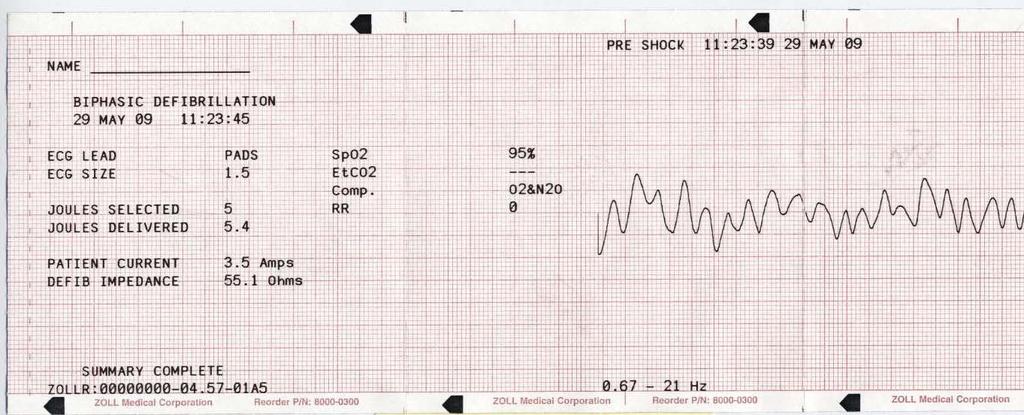 Yhteenvetoraportti Defibrillaatiomuoto Yhteenvetoraporttiin tulostuu 6 sekuntia iskua edeltäviä ja 9 sekuntia iskun jälkeisiä potilaan EKG-tietoja.